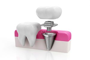 Implante aditamento corona en la Clínica Dental Mississippi en Madrid, al mejor precio y con los mejores especialistas