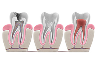 endodoncia